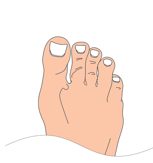 How to put Solewells foot pads on to your foot